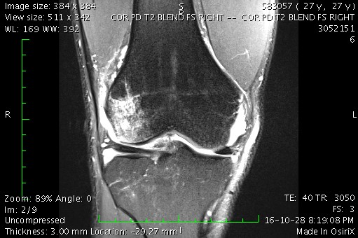 This is an MRI image of my right knee. I have no idea how doctors read this stuff!